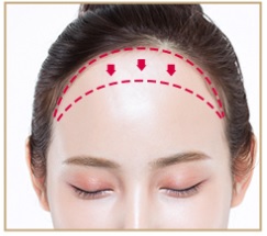 [공유] 이마축소술 두피탄력도 측정? 정말 그렇게 하는게 맞아요? 저는 몇 센티를 줄일 수 있나요? 관련 이미지 2