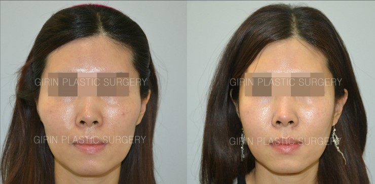 앞광대가 크게 발달한 유형 관련 이미지 1