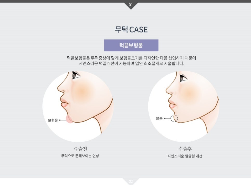 돌출입 수술, 꼭 양악으로 해결해야 할까? 관련 이미지 2