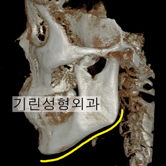 앞턱 끝까지 자르는 긴곡선절제술 (전후CT) 관련 이미지 3