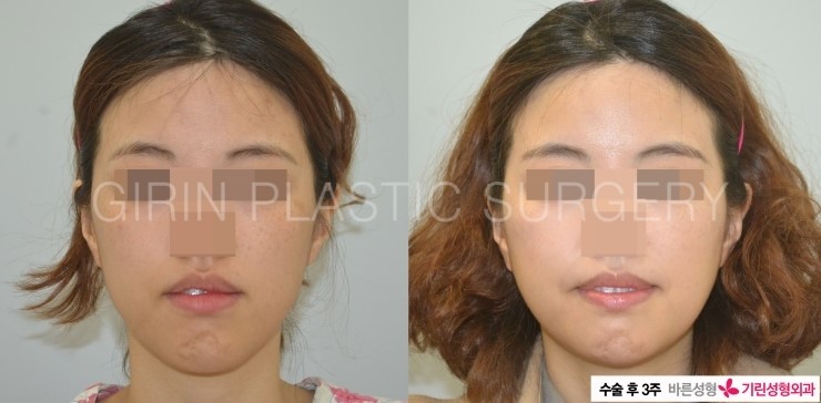 긴곡선브이라인 수술후3주 ->4주 경과 관련 이미지 1