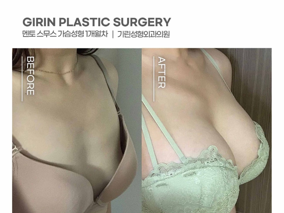 서울가슴성형 볼륨감 차이를 위해 관련 이미지 1