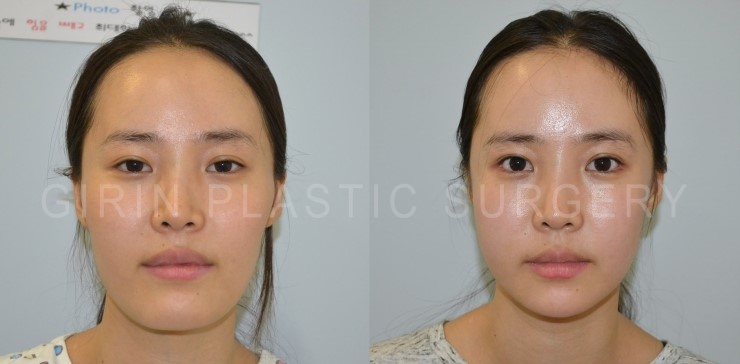 턱길이줄임+브이라인+광대고정술 16일/30일 경과 관련 이미지 2