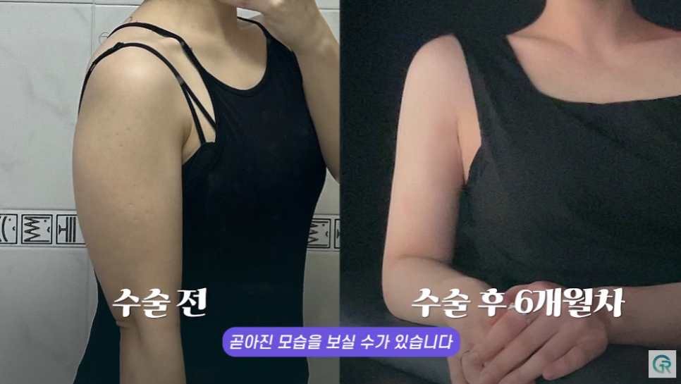 [기린성형외과] 뼈 팔뚝 된 비결 알려줄게_팔뚝 지방흡입 수술일지 관련 이미지 17