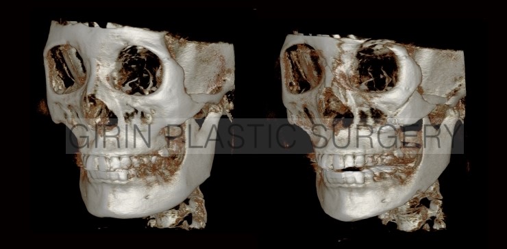 브이라인, 광대고정 사례 관련 이미지 3