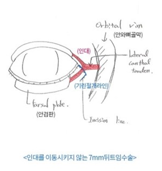 뒤트임 눈성형수술, 기린만의 특별화된 7mm 뒤트임. 관련 이미지 1