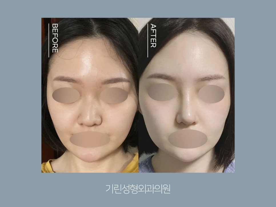 서울코성형 신중하게 정해야 관련 이미지 11