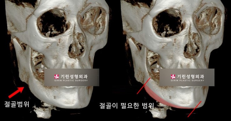 안면윤곽재수술 시 고려해야 할 점 관련 이미지 5