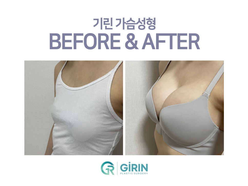 강남가슴성형 달라질 라인 기대하며 관련 이미지 14