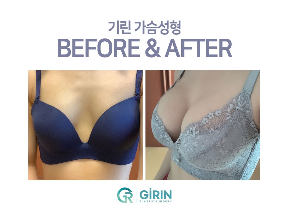강남가슴성형 달라질 라인 기대하며 관련 이미지 6