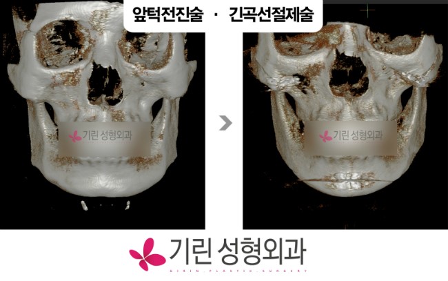 브이라인수술 : 앞턱전진술의 병행 관련 이미지 1