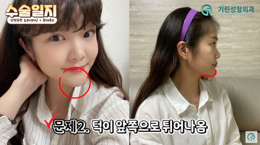 [기린성형외과의원] "카리나가 되고싶어요"_안면윤곽 수술일지 관련 이미지 4