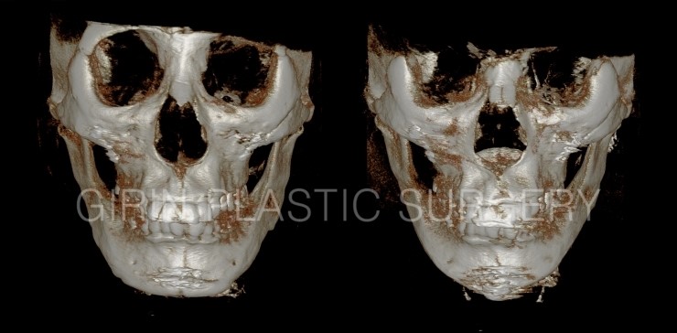 티절골재수술사례 관련 이미지 1