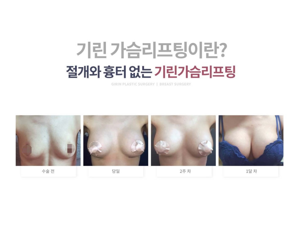 처진가슴성형 자신감 회복을 위해 관련 이미지 1