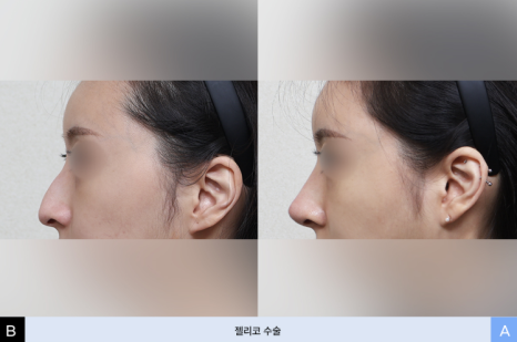 젤리코란? 비개방 코수술과 일반 코수술의 차이 관련 이미지 5