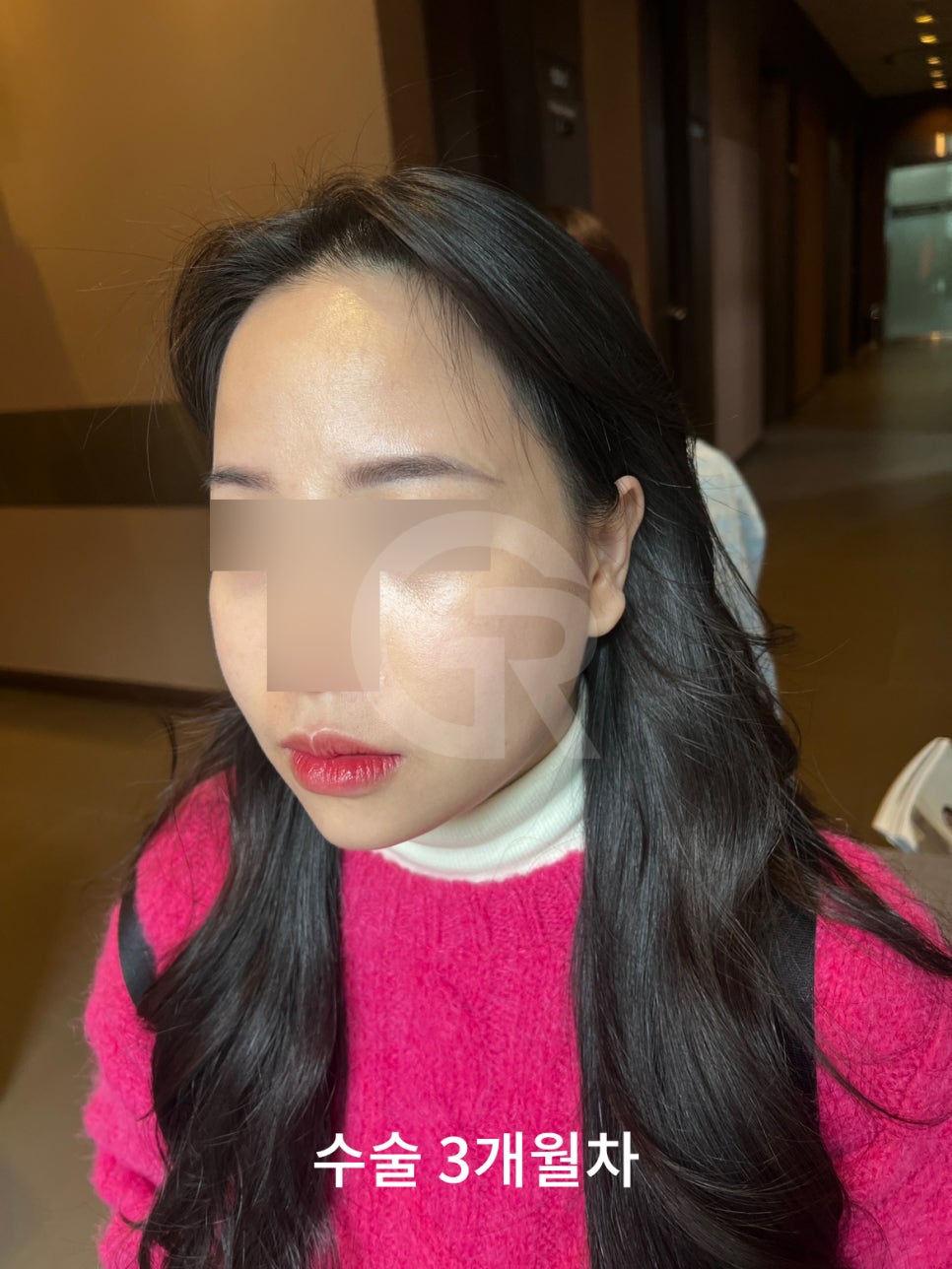 연조직윤곽술, 시간이 지날수록 자연스러운 얼굴선 관련 이미지 6