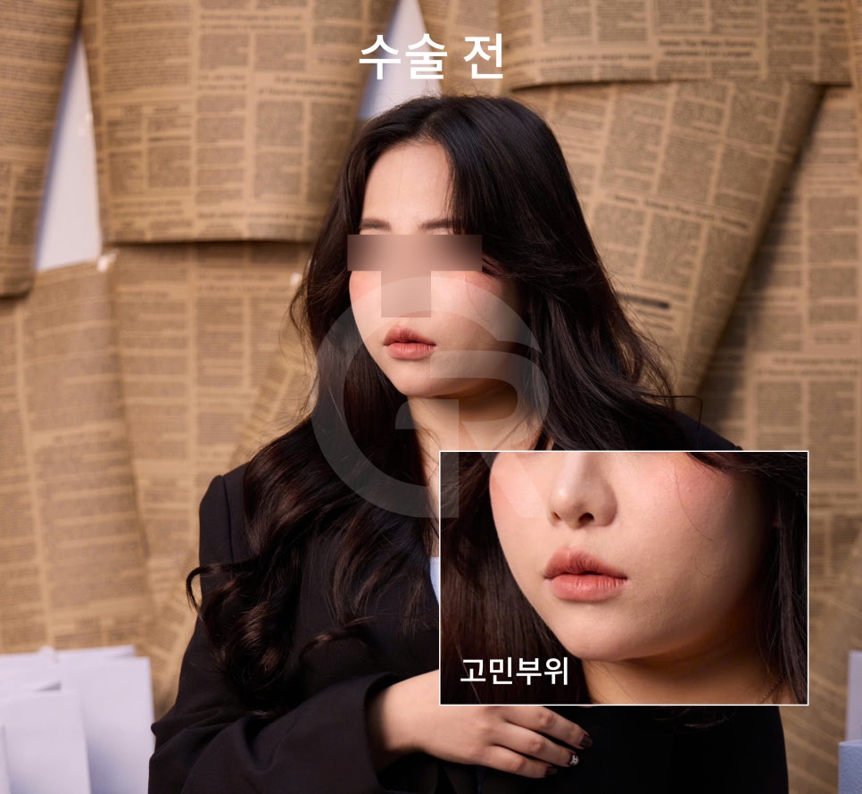 연조직윤곽술, 시간이 지날수록 자연스러운 얼굴선 관련 이미지 1