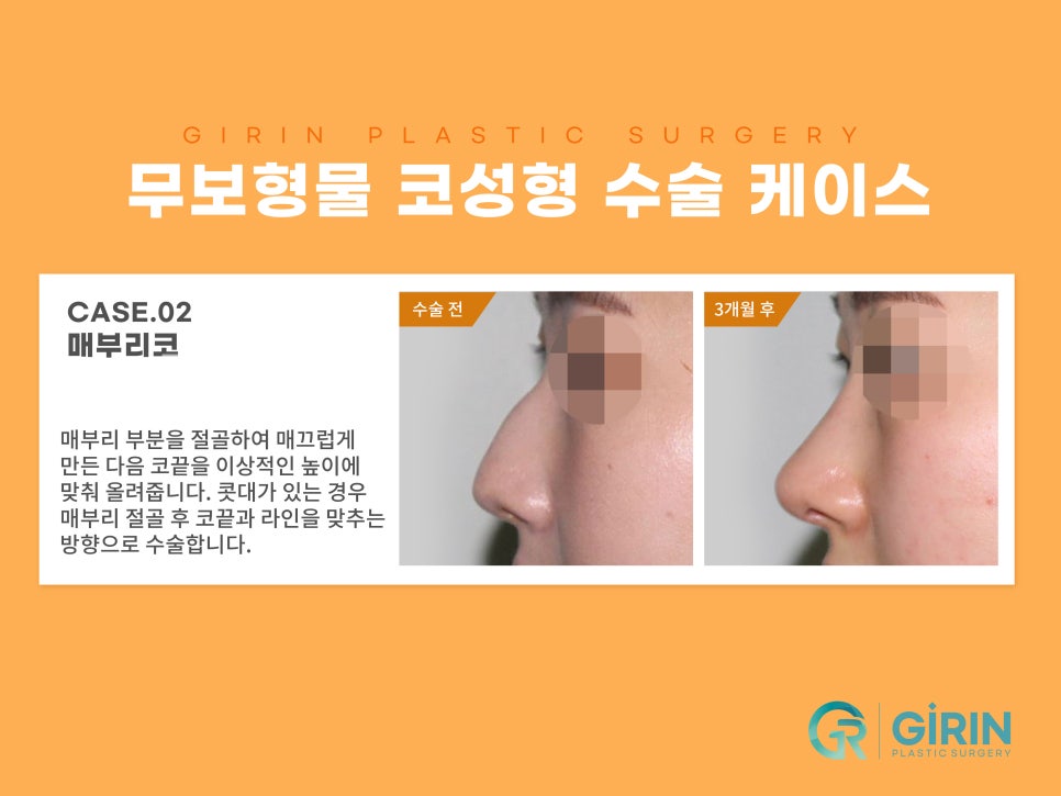 무보형물 코수술 자연스러운 코라인 관련 이미지 6