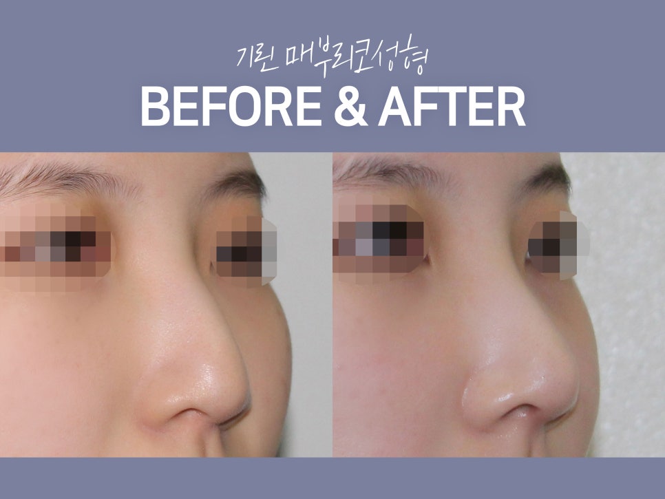 매부리코수술후기 방법까지 확인해 관련 이미지 2