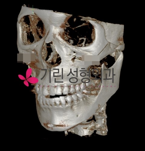 긴곡선 후 측면효과 관련 이미지 2