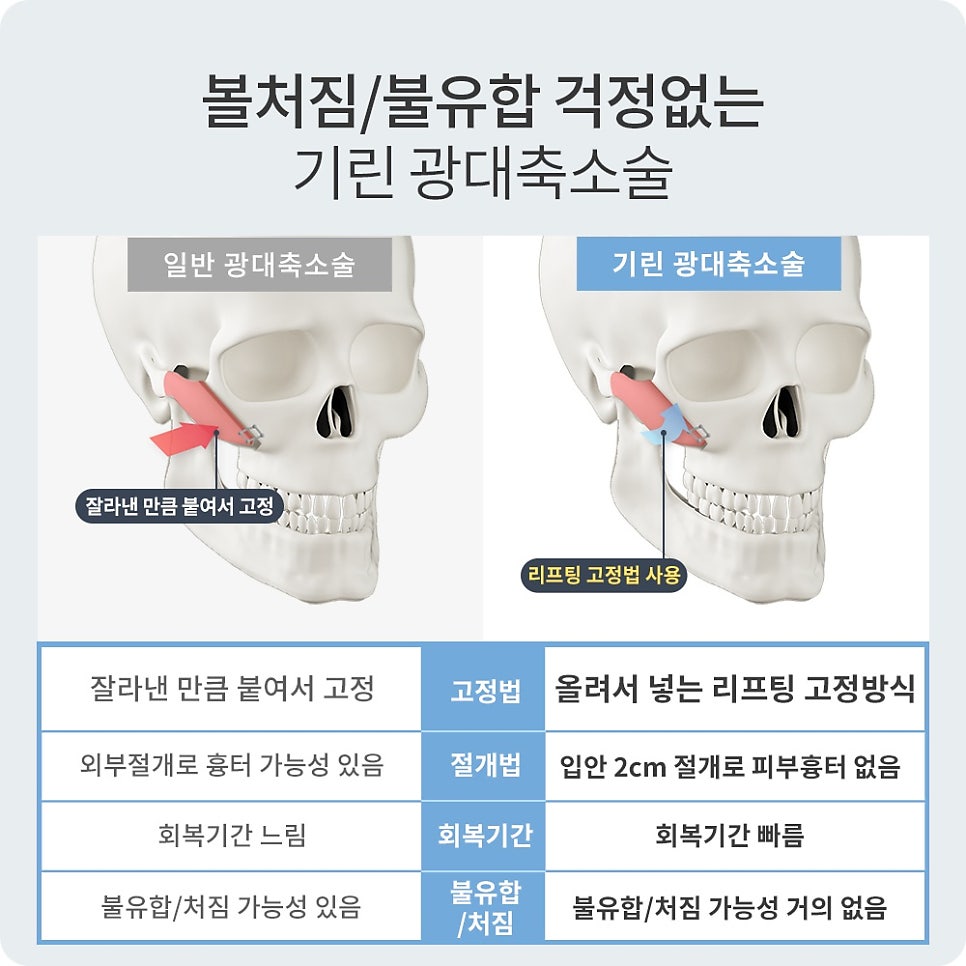 안면윤곽후기? 사실 도움 안 되는 이유 관련 이미지 7