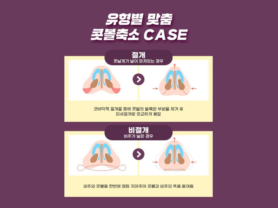 콧볼축소수술전후 얼마나 달라질까 관련 이미지 7