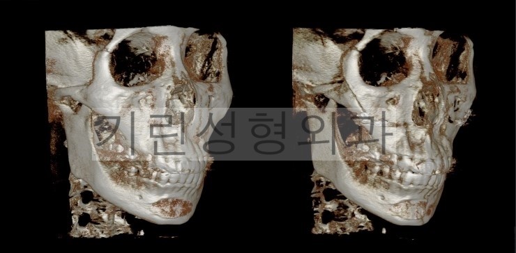 광대뼈고정, 볼처짐 아큐스컬프 사례입니다. 관련 이미지 2
