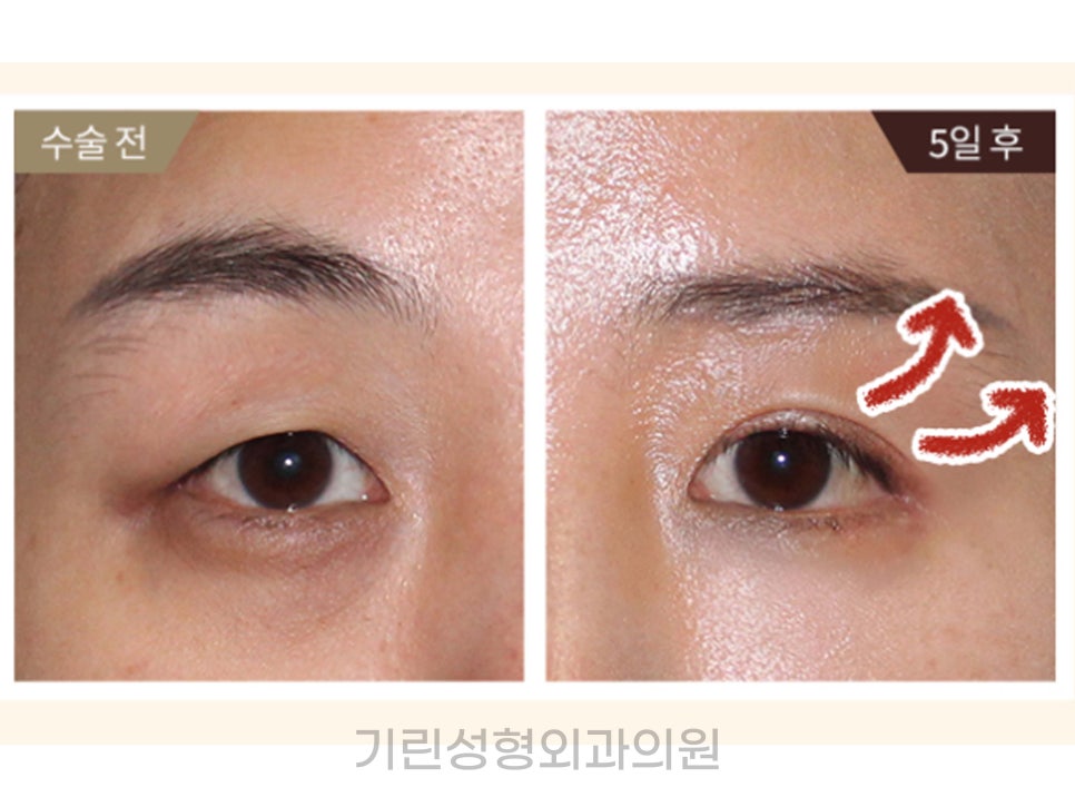 상안검수술회복기간 확인하자 관련 이미지 3