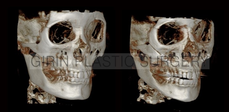 브이라인, 광대고정 사례 관련 이미지 2