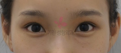 광대뼈와 뒤트임수술의 시너지효과 관련 이미지 2