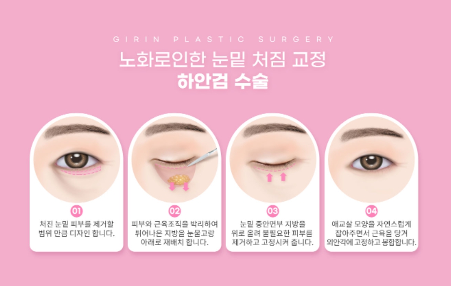 눈밑지방제거수술 하안검 선택의 폭이 넓어졌어요! 관련 이미지 5