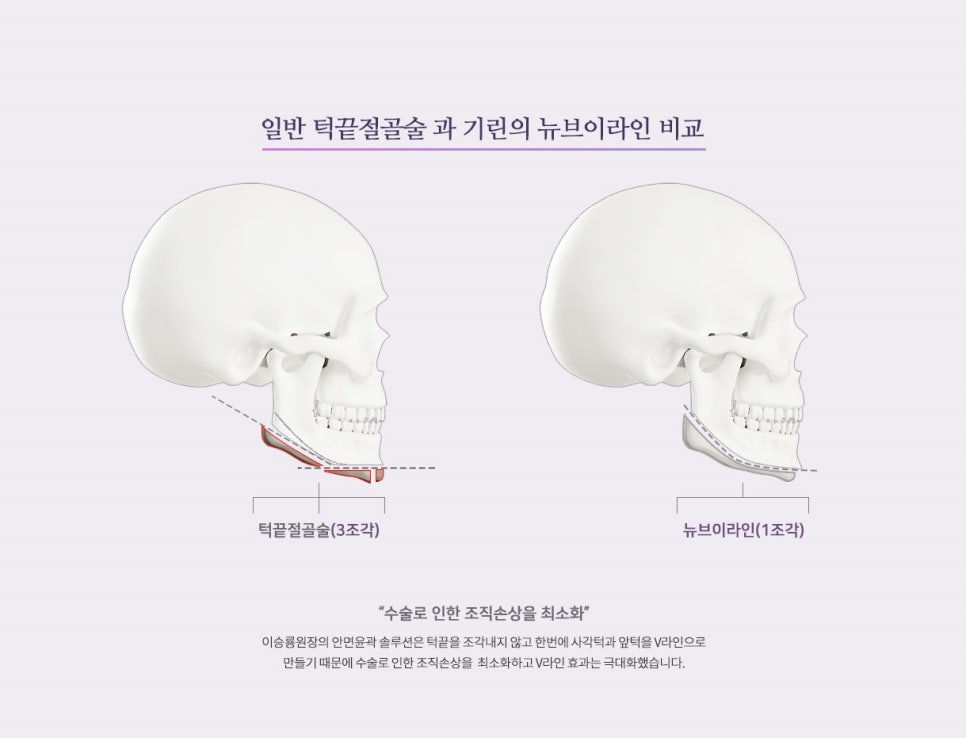 [뉴브이라인] 45도 라운딩 브이라인 절골술로 작은 얼굴 만들기 관련 이미지 2