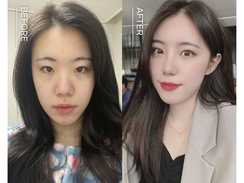 강남코성형 차이점이 있어야 관련 이미지 12