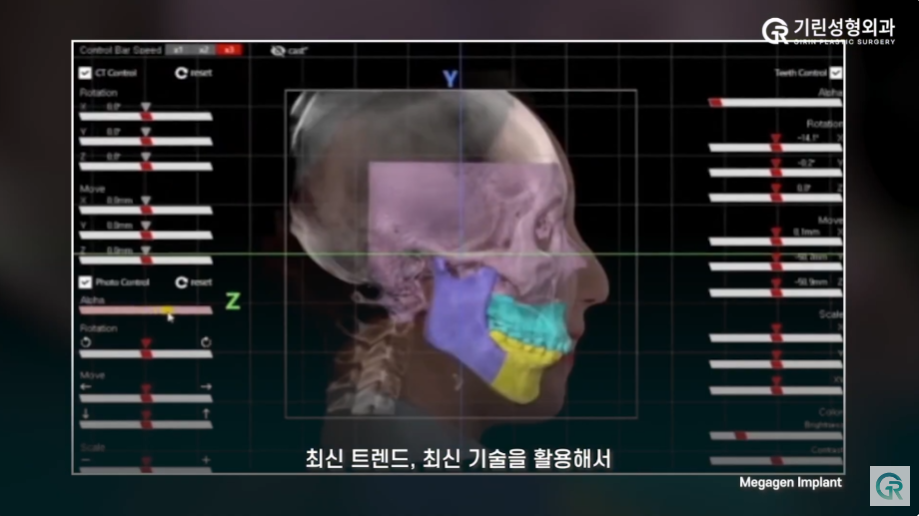 [기린성형외과] 양악수술, 어느 병원으로 가야 성공적이고, 안전할까? 관련 이미지 10