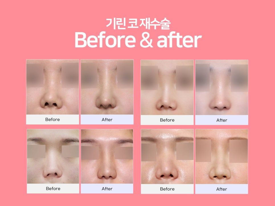 서울코재수술 마지막으로 살펴볼것 관련 이미지 6