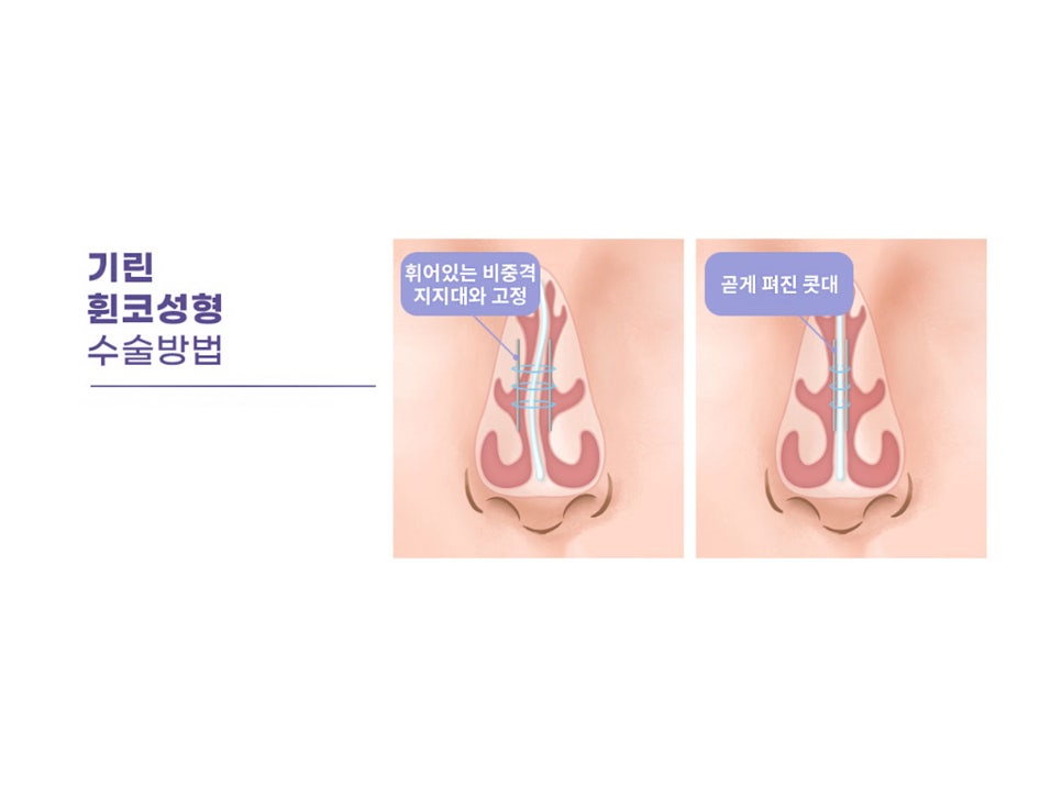 휜코성형잘하는곳 꼼꼼하게 따져보자 관련 이미지 10