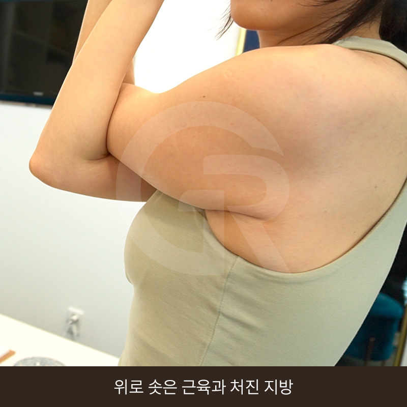 요가로 소용없던 굵은 팔뚝 지방흡입 수술 후기 관련 이미지 6
