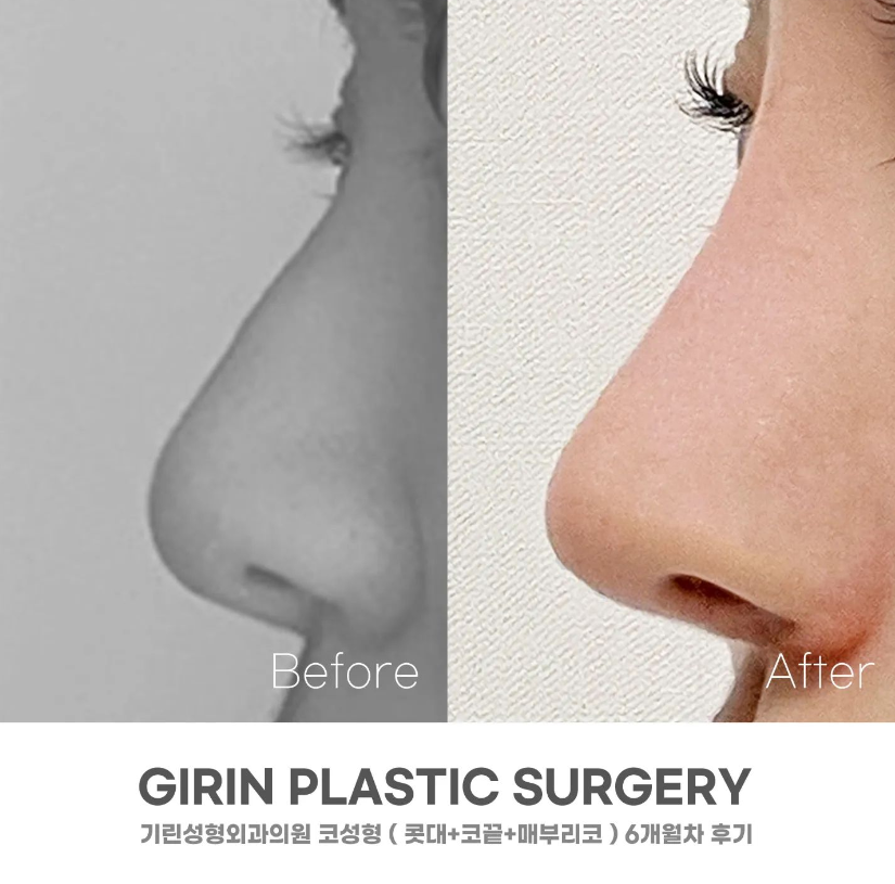 코성형 종류 비교하고 맞춰서 관련 이미지 10