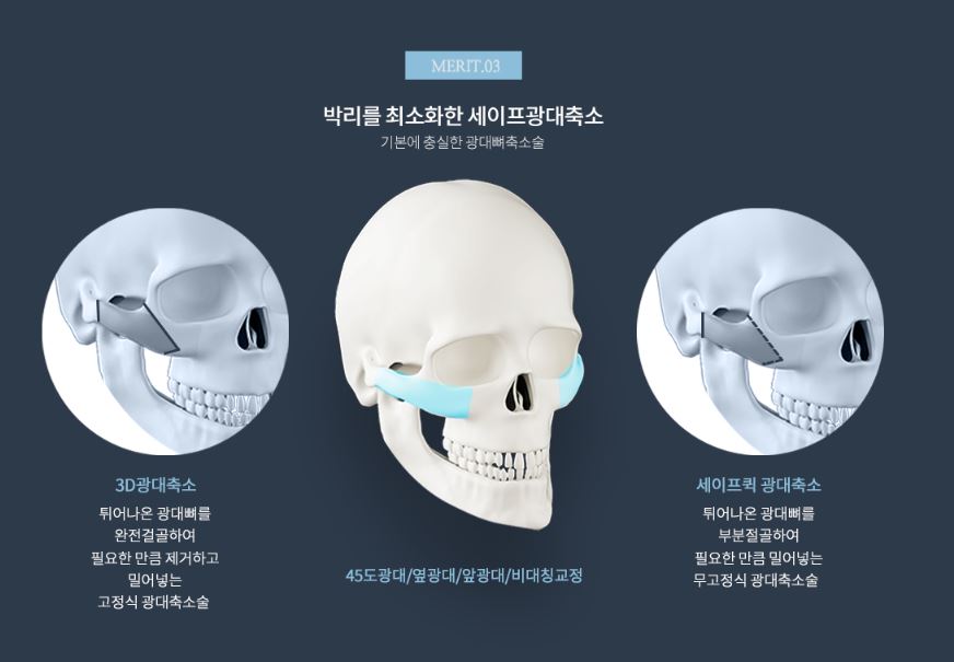 [사각턱축소 최다수술 이승룡원장] 태국에서 온 그녀의 윤곽 수술 후기 리얼 스토리&hearts; 관련 이미지 12