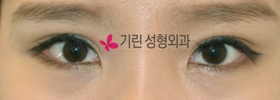 자연유착쌍꺼풀과 매몰법 차이? 관련 이미지 2