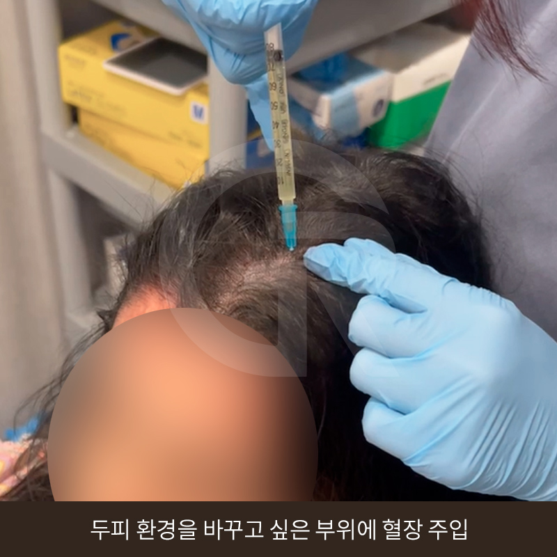 탈모 고민 두피 줄기세포 치료, 가격이 다른 이유는? 관련 이미지 13