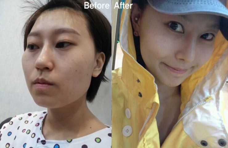 절골을 통한 매부리코 교정수술 (B&A) 관련 이미지 2