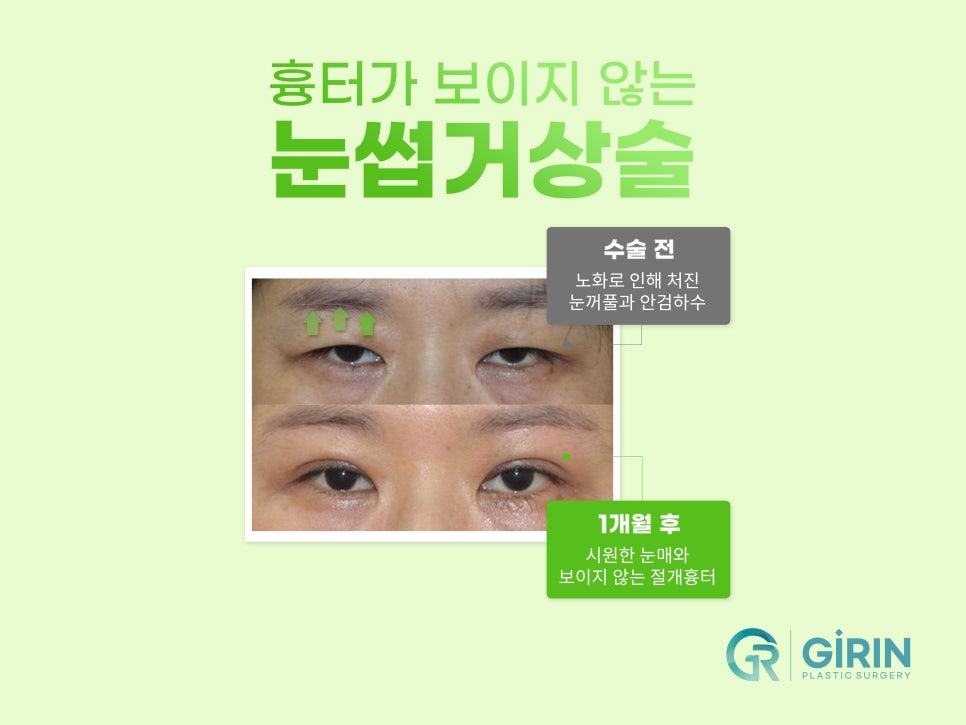 상안검수술잘하는곳 알아본다면 관련 이미지 11