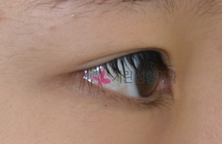 쌍꺼풀수술: 티안나는 쌍꺼풀수술 관련 이미지 1