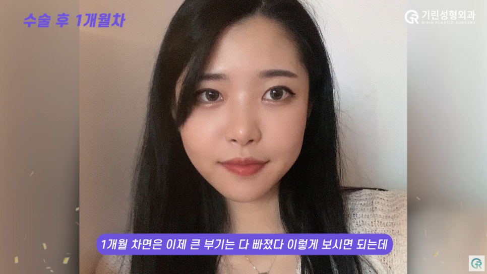[기린성형외과의원] ❌보정어플은 당장 삭제❌_윤곽3종 수술일지 관련 이미지 11