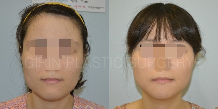 긴곡선브이라인 16일째 경과 관련 이미지 1