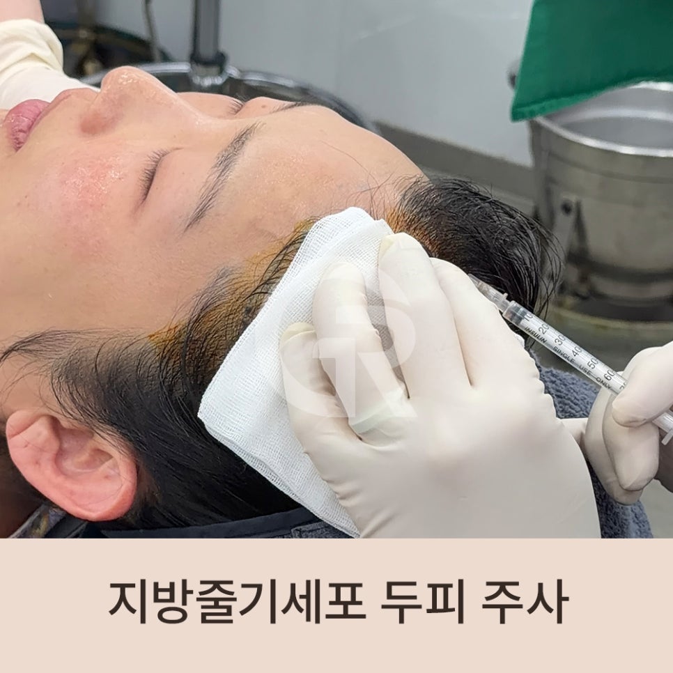 "머리숱이 없어요" 가르마 탈모 환자 줄기세포 주사 관련 이미지 6