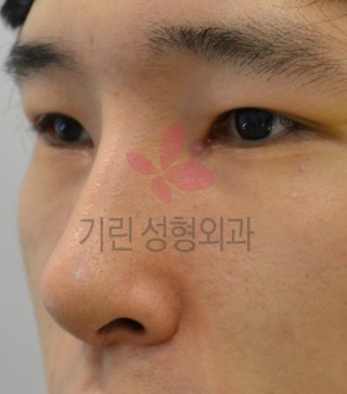 매부리코성형 : (남자코성형 전후 - 수술후 7일) 관련 이미지 2