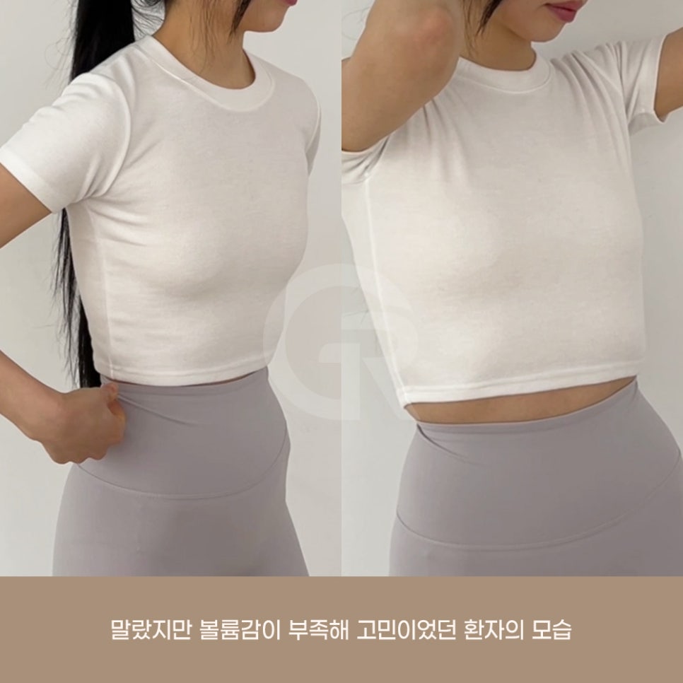 기린성형외과 가슴성형 패션 인플루언서의 고민 해결 관련 이미지 3