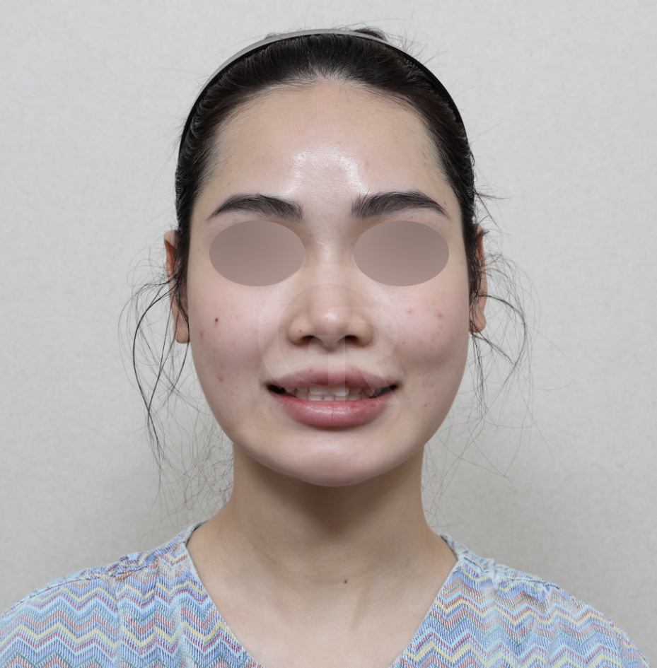 연조직윤곽술, 비대칭을 최소화하는 방법 관련 이미지 2